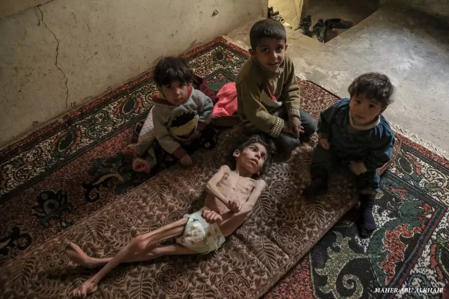 الطفلة "روان الناصر" واحدة من مئات الأطفال يواجهون الموت بسبب نقص التغذية والحصار على الغوطة الشرقية