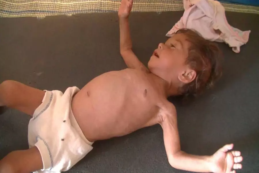 الفقر وسوء التغذية ينهكان جسد الطفلة تسنيم (قصة إنسانية)