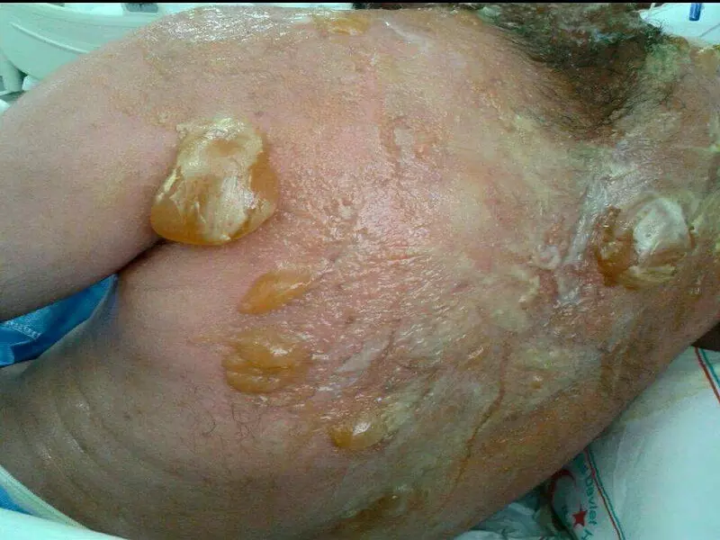 الساكت يؤكد استخدام تنظيم الدولة "الخردل" في قصف مارع الأمس