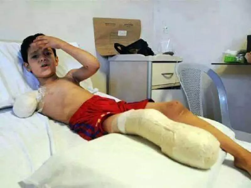 في سوريا... الآلاف فقدوا أجزاء من أجسادهم .. هل من مهتم ؟؟؟