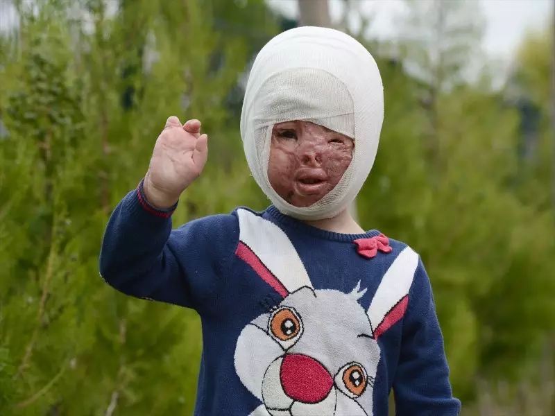 نار الأسد تشوه وجه الطفلة "جنى" وتحيل حياتها جحيماً