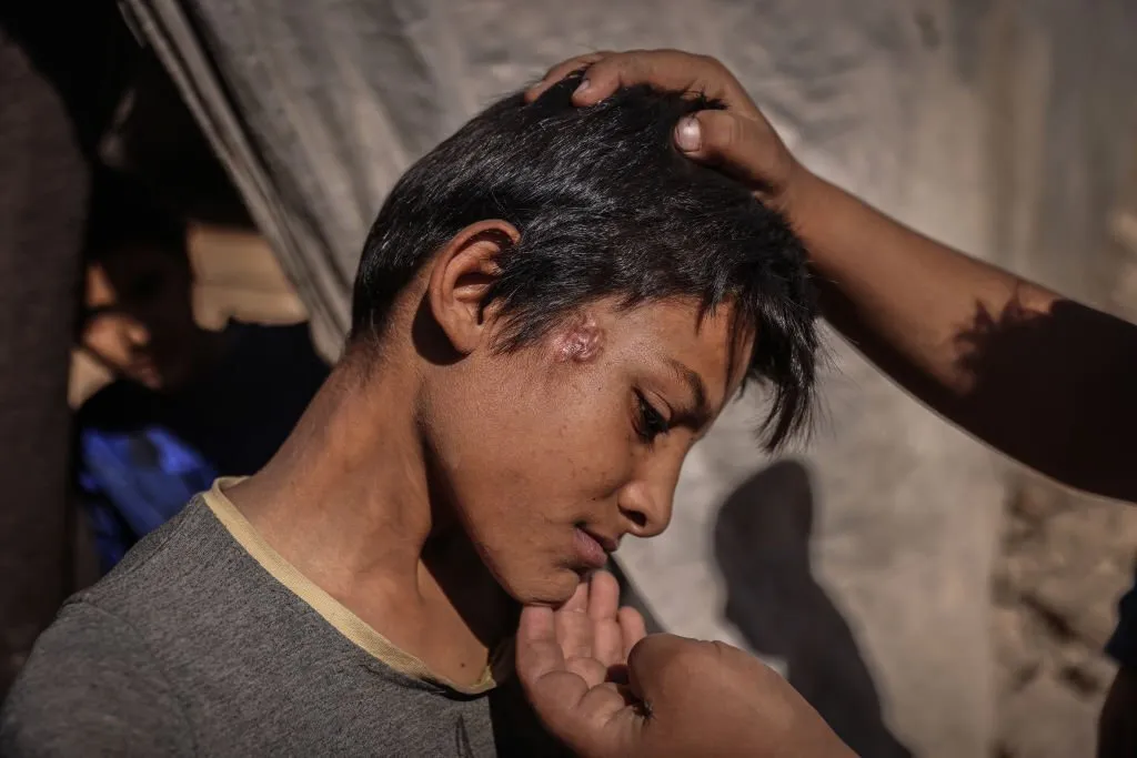 "استجابة سوريا" يؤكد انتشار "الأمراض الجلدية" في أكثر من 478 مخيماً للنازحين شمال غرب سوريا