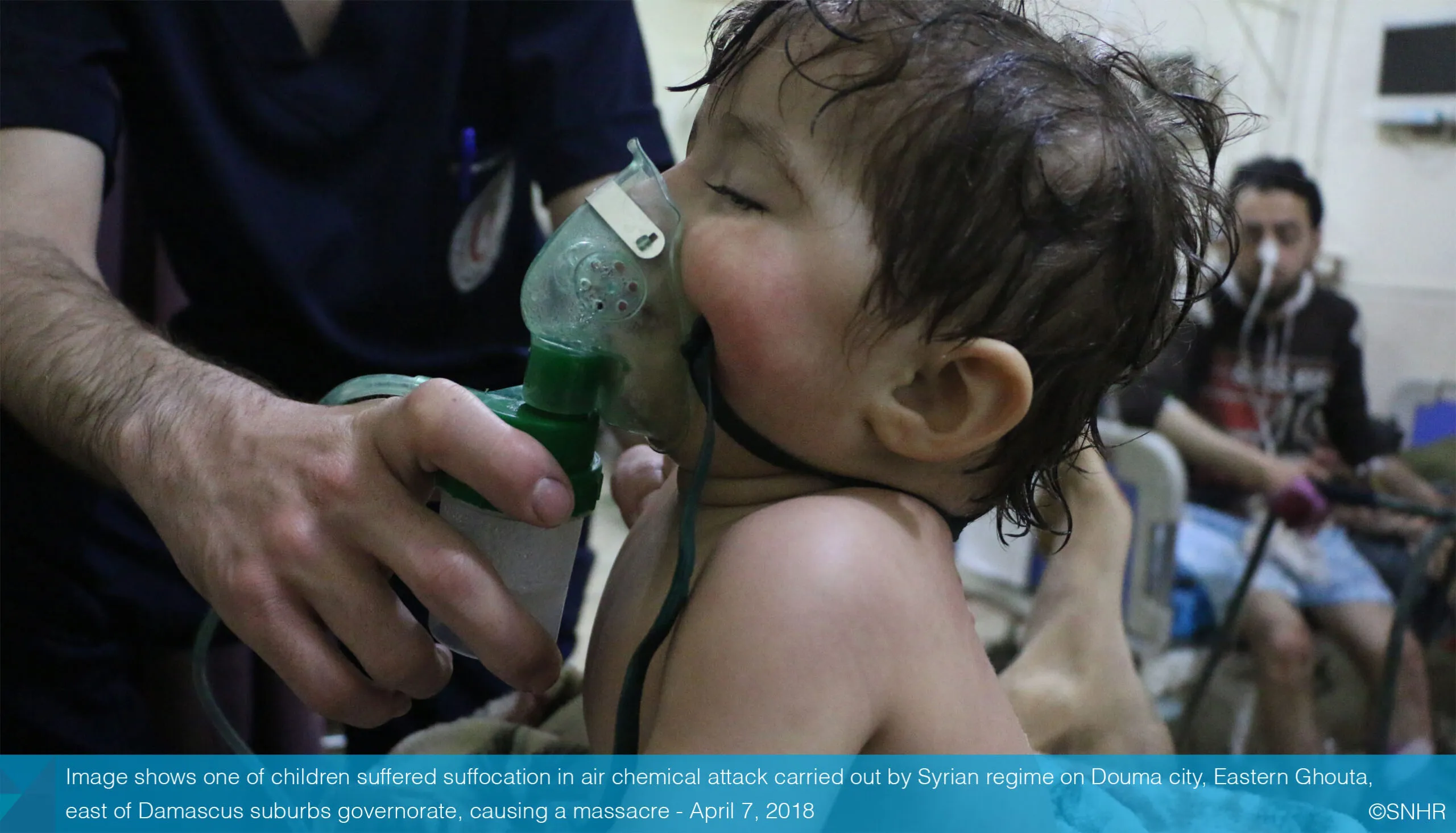 طفل مصاب بإختناق بالكيماوي الذي ضرب دوما عام 2018 من قبل نظام الأسد