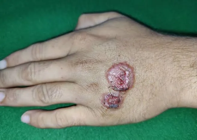 انتشار اللشمانيا في بلدة التح يفاقم معاناة الأهالي ويطرح تحديات صحية متزايدة