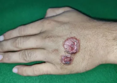 انتشار اللشمانيا في بلدة التح يفاقم معاناة الأهالي ويطرح تحديات صحية متزايدة